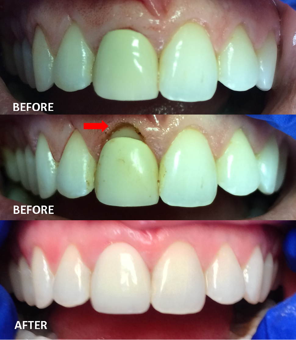 front teeth crowns before and after